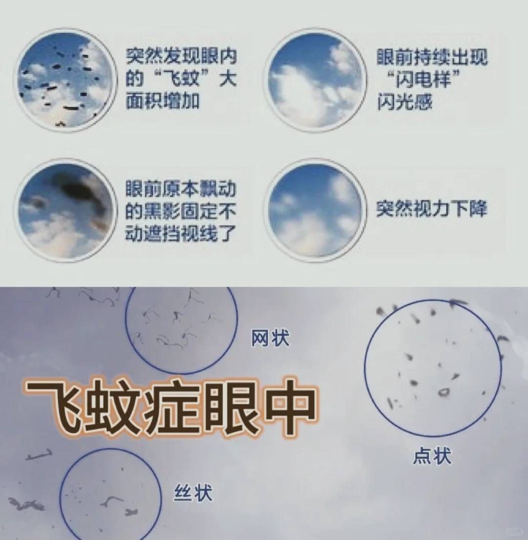 这可能是飞蚊症!