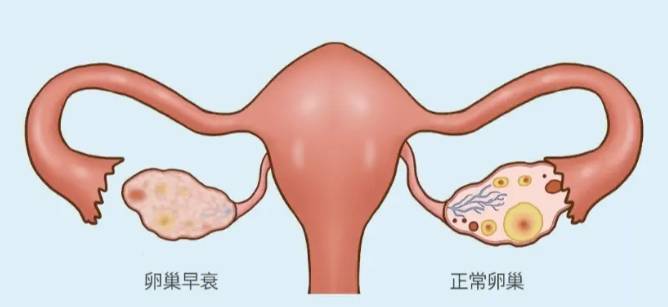 卵巢早衰出现时有什么症状？这5个信号女性都应该了解