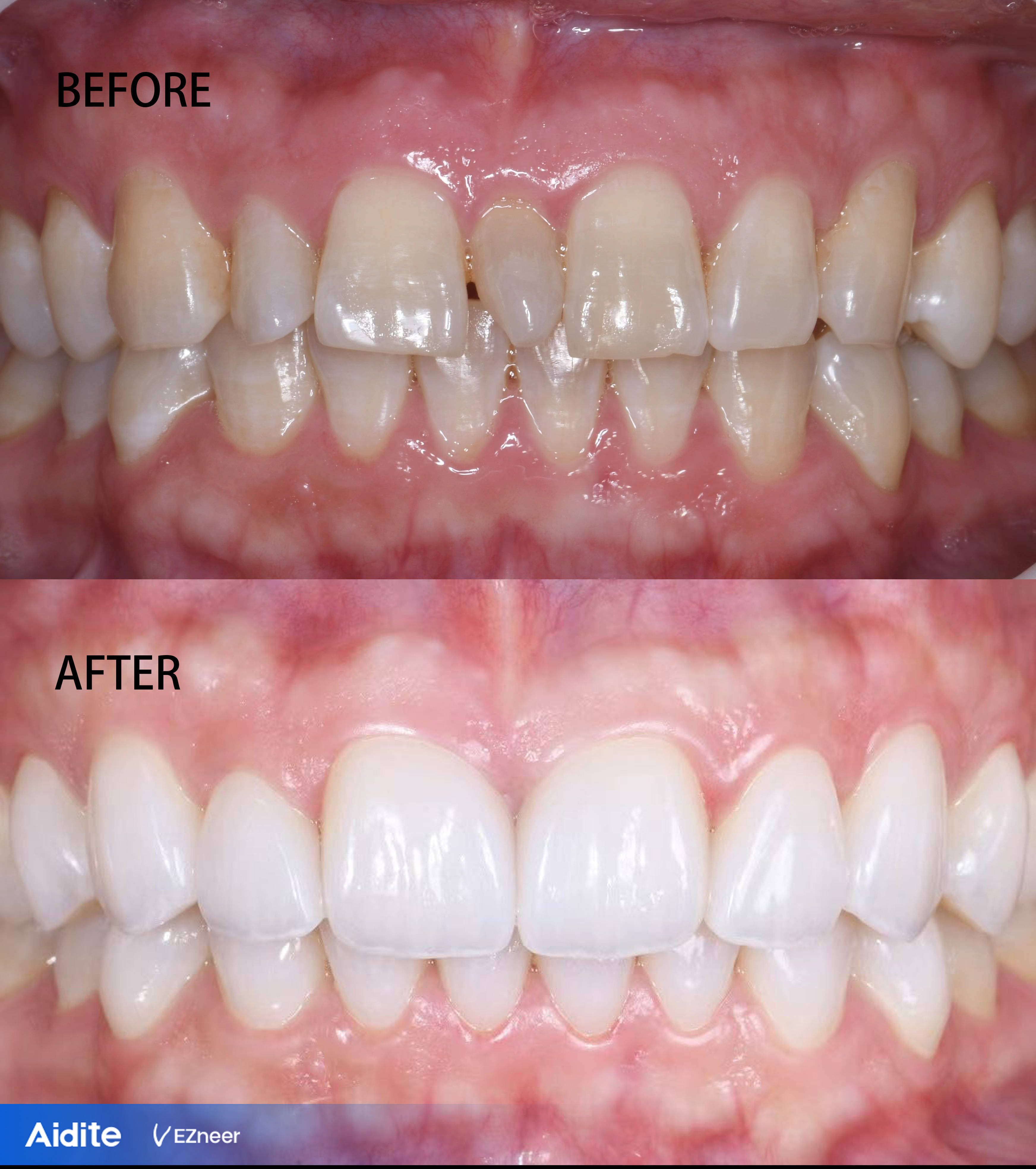 龅牙烤瓷牙前后对比图片