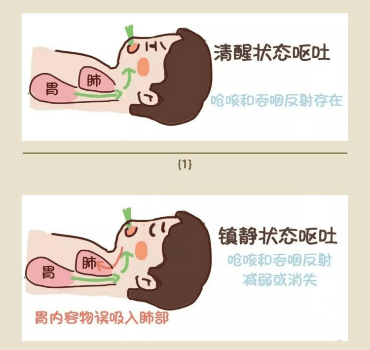 如果发生呕吐,可以通过剧烈咳嗽将食物或水排出气道,一般不会造成误吸