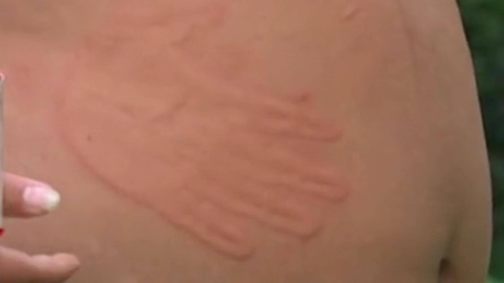 回顾:男子称有超能力,皮肤不用笔就能写字,手一碰就留下手掌印