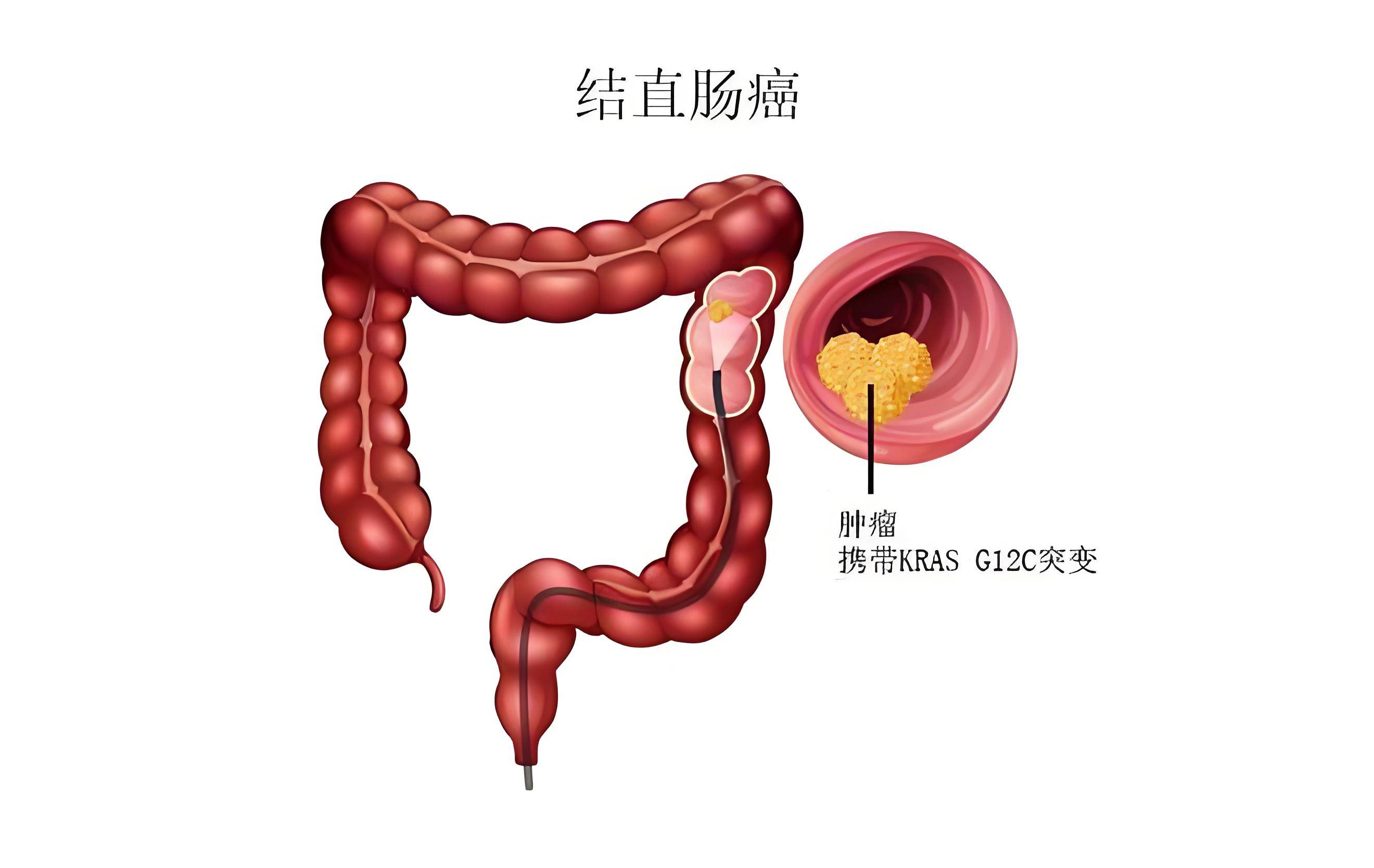 警惕结直肠癌