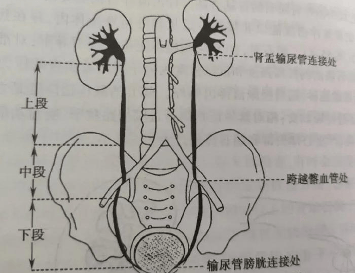 输尿管的三个狭窄