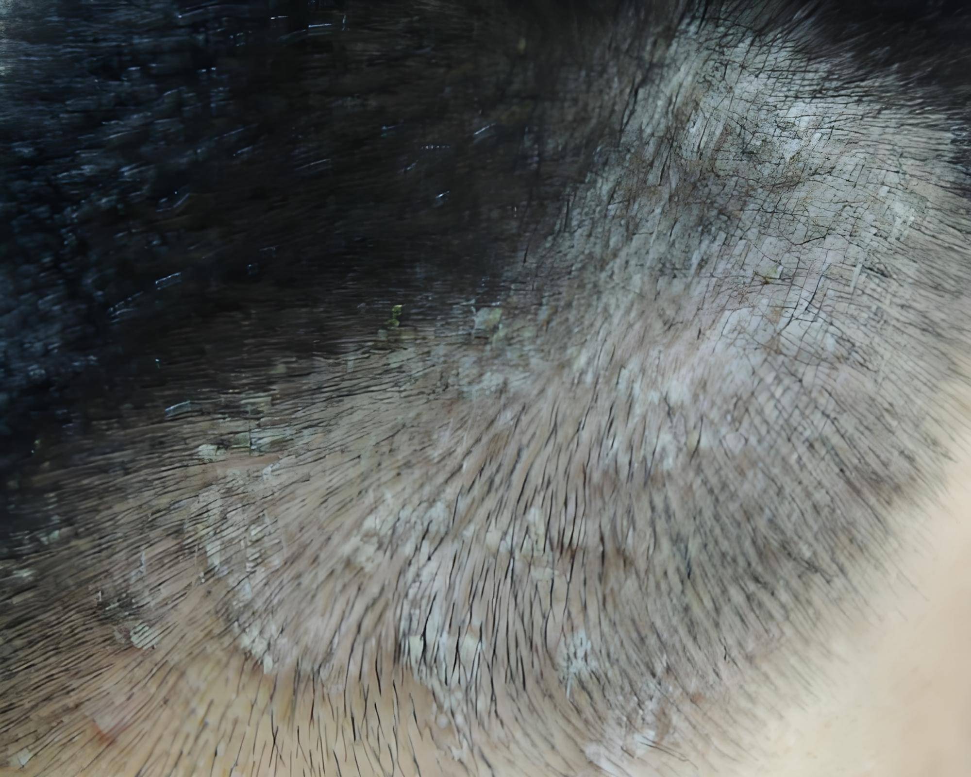 张弘医生:银屑病头皮护理指南:做好这3步,减少皮屑困扰