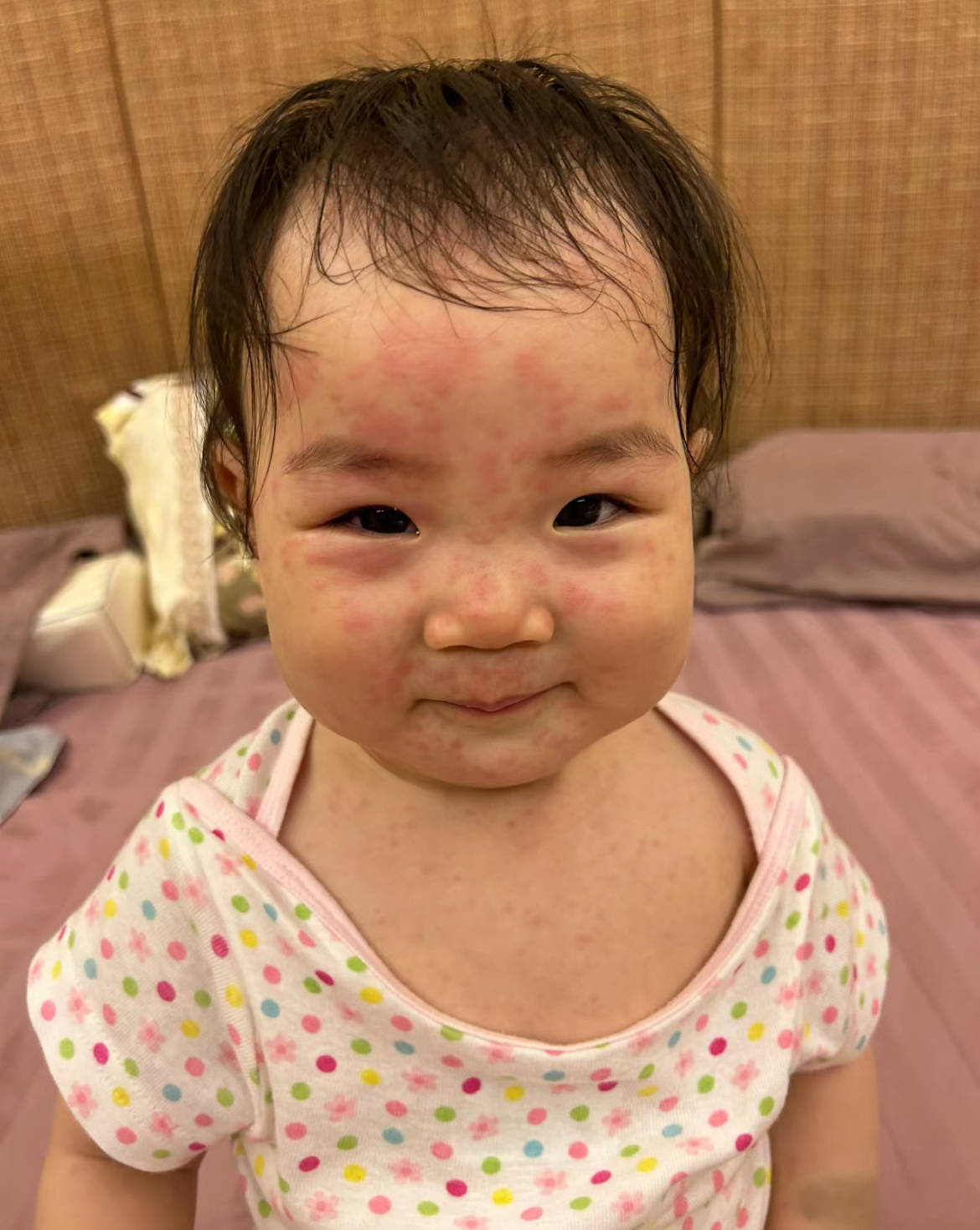 幼儿急疹是每个孩子都会出吗？