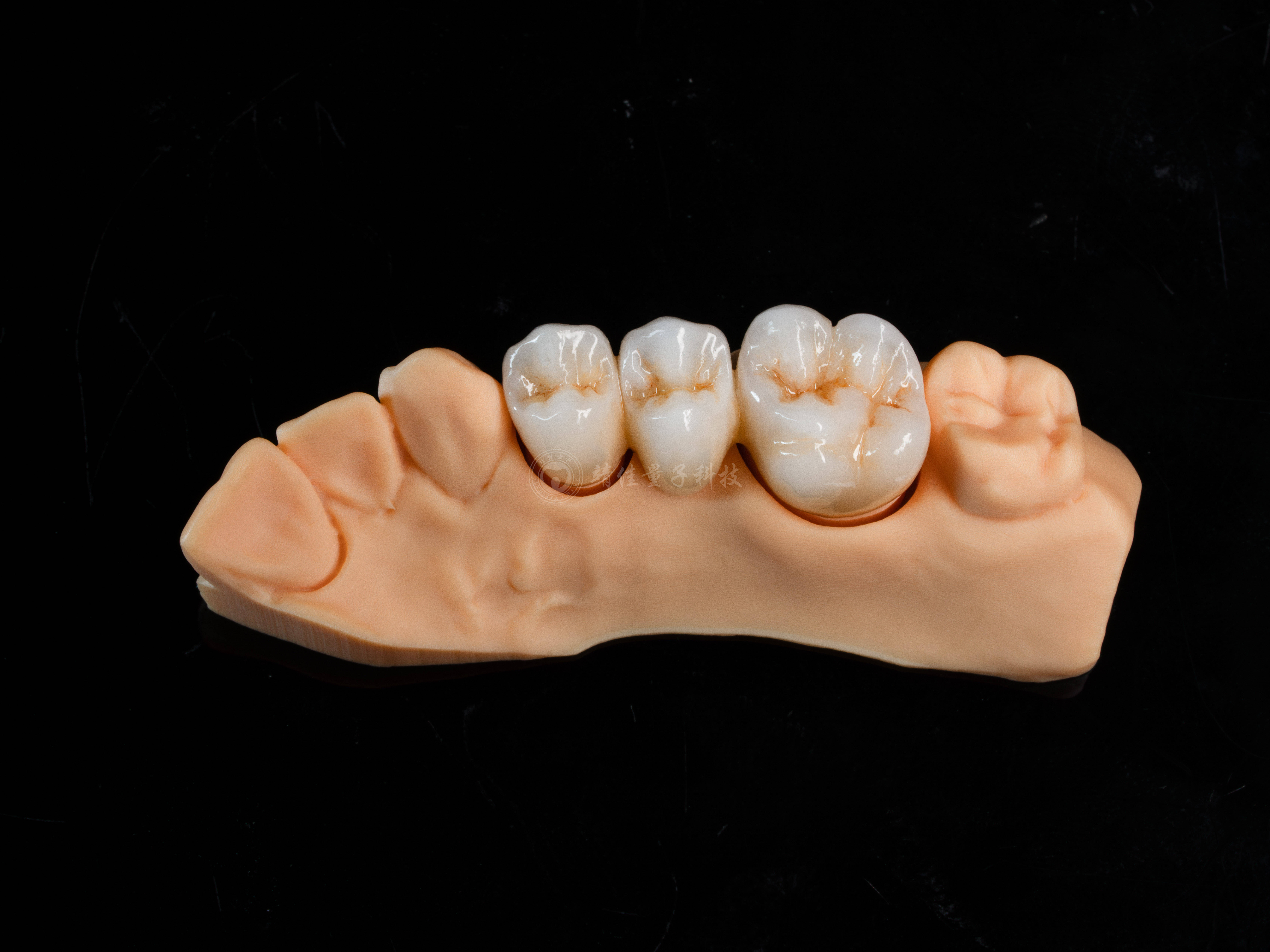 义齿固定桥修复的生理基础及生物力学分析