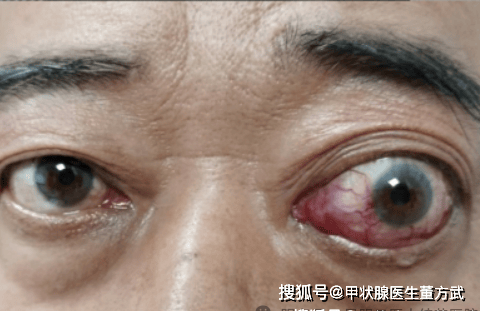 甲亢突眼能恢复正常吗?甲亢患者当如何做好眼部护理?