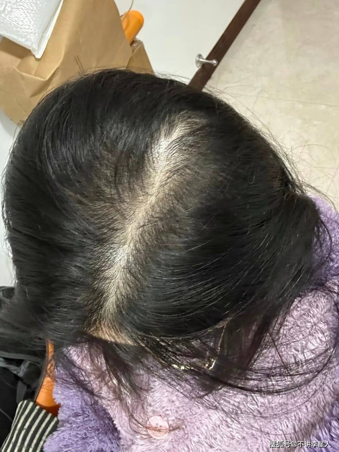 应对压力脱发的个人心得我的几点尝试