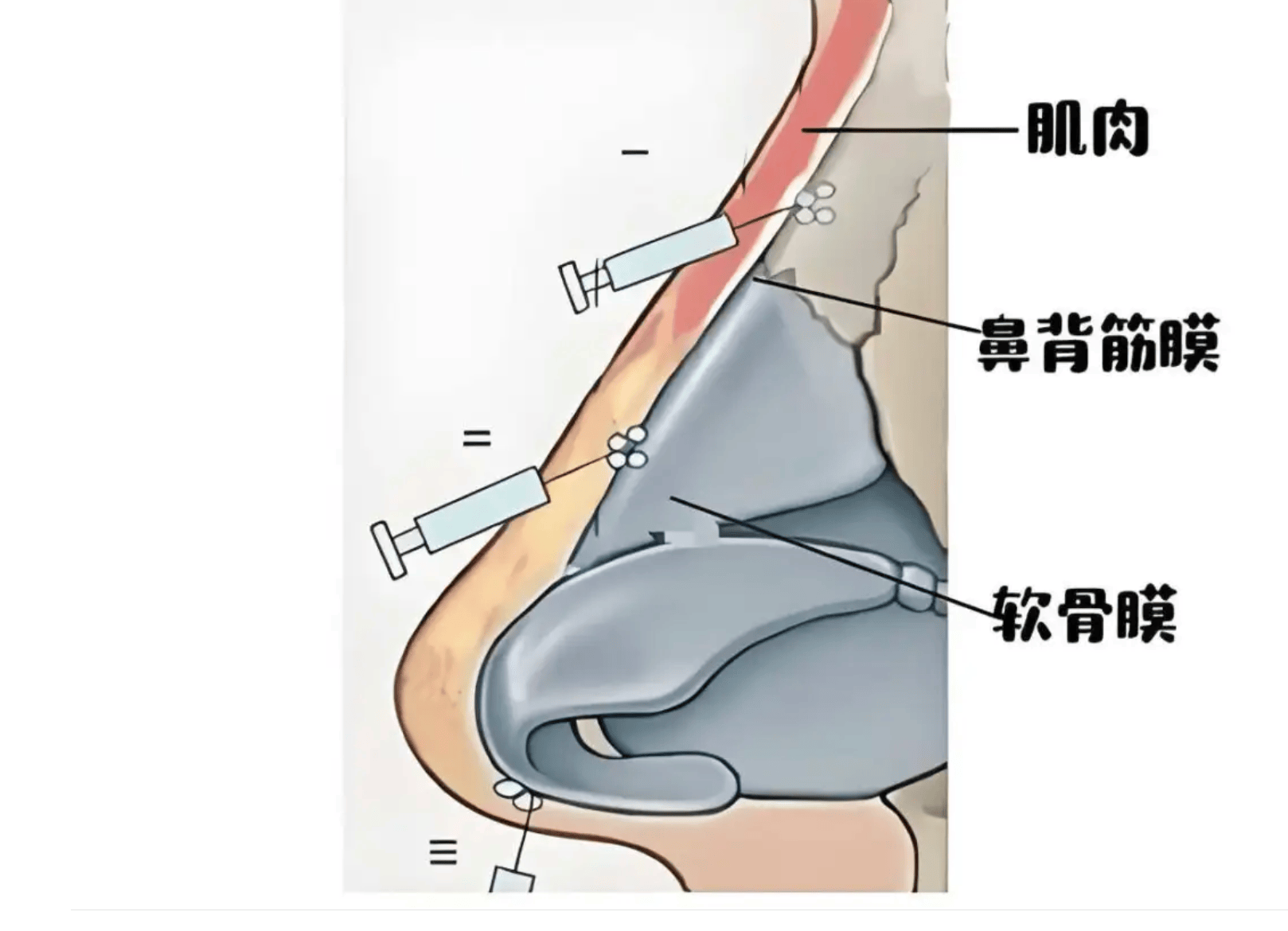 美丽课:钝针注射隆鼻,为什么容易歪?