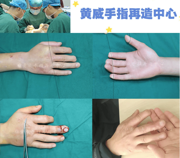 全程护航，黄威手指再造为断指患者带来希望