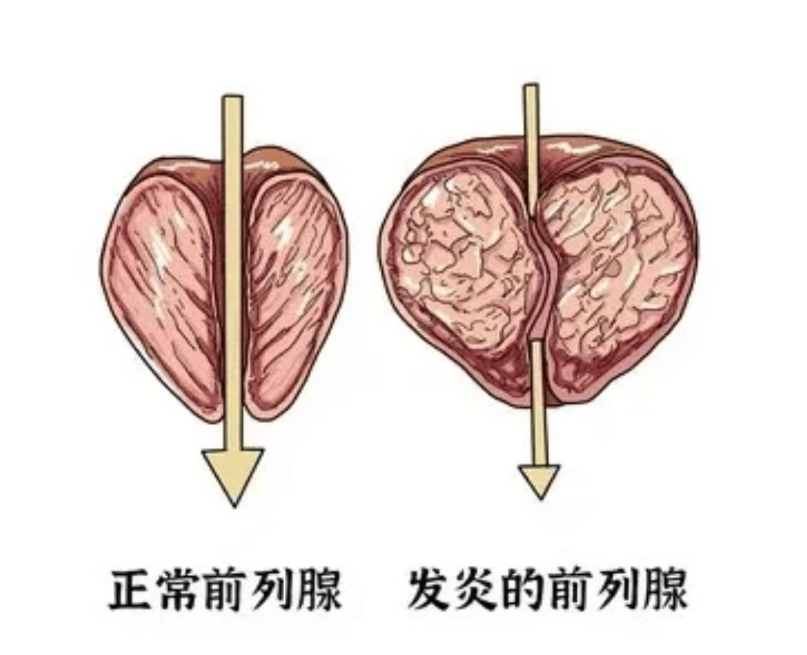 30岁以上男性前列腺问题引争议，隐患多，调理产品咋选？