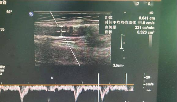 測肱動脈血流量(fv)231 ml/min,血管阻力指數(ri)0.