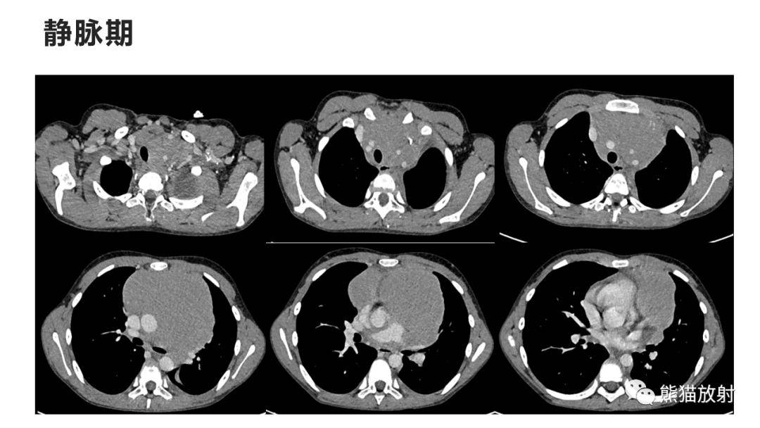 【省立影像读片】青少年前中纵隔肿瘤24.01_相关_内容_汇报