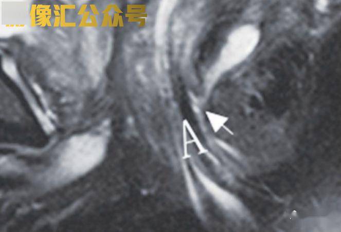 67肛瘻mri一看就頭疼?看看這個診斷要點!_括約肌_直腸_信號