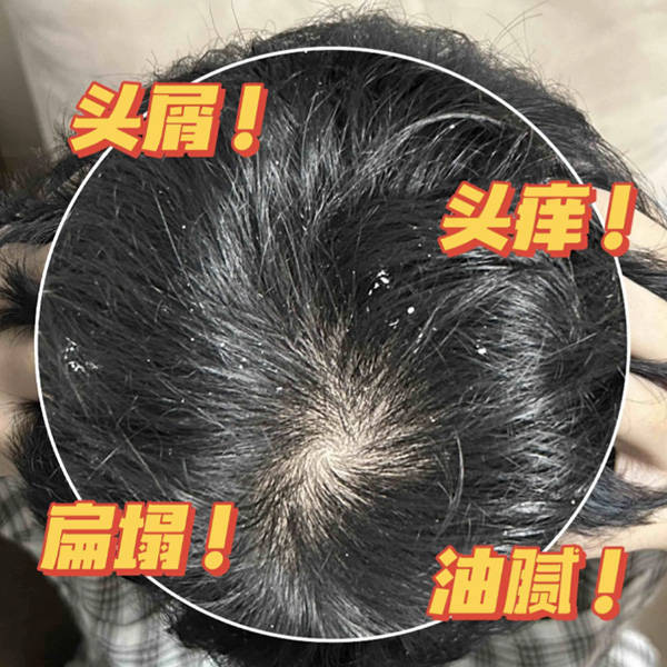 那种洗发水的去屑好?发根洗发水推荐