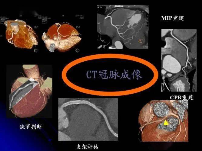 冠脈cta全稱是指冠狀動脈增強cta,它是將患者的靜脈當中注射造影劑,讓