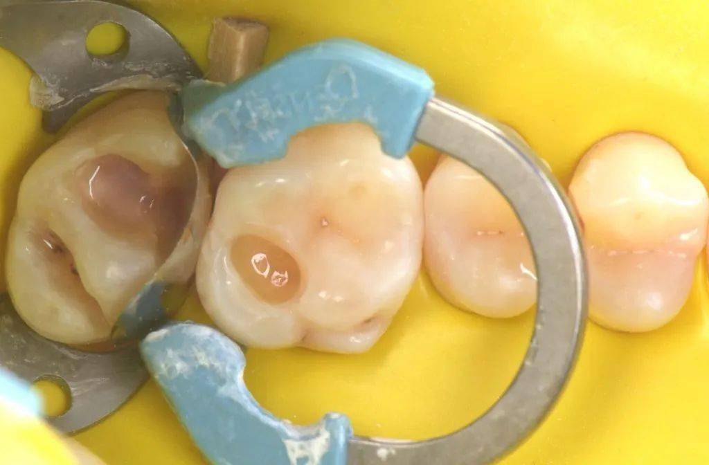 光固化垫底材料的使用时机和原因_ionosit_缝隙_牙齿