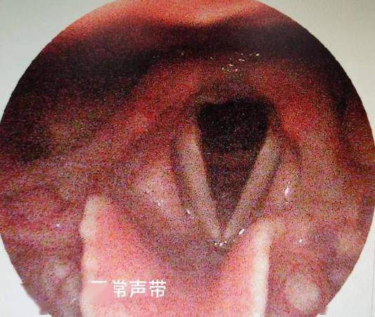 声带整容图片