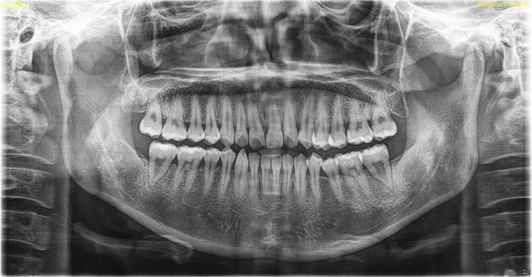 限200名口腔全景片,建立口腔档案)脱敏抛光,口内常规检查,(内含舒适