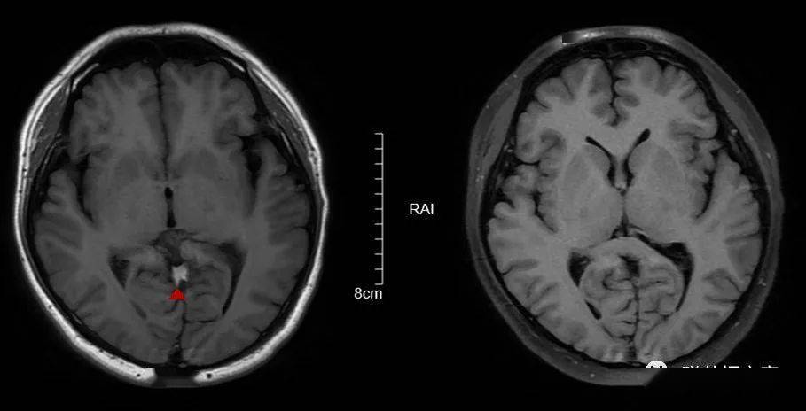 扫盲:头颅mri该如何扫描!_序列_phase_对比