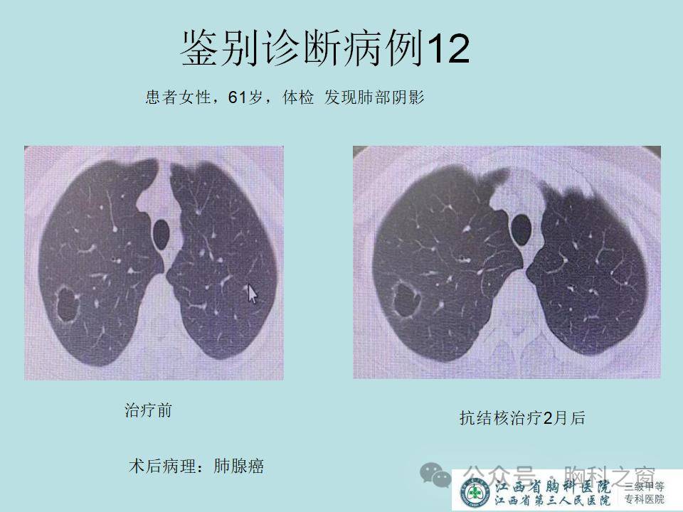 病原學陰性肺結核的診斷與鑑別_原文_公眾_登陸