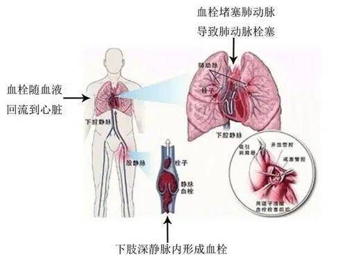 就會沿血液循環途徑,下腔靜脈-右心房-右心室,最終進入肺動脈,造成肺