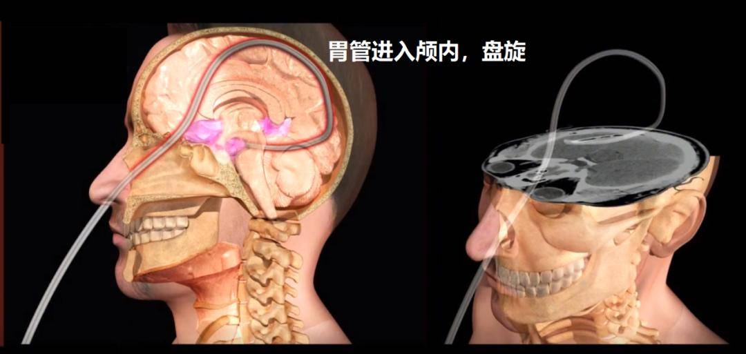 医护人员竟将胃管插入病人大脑!_操作_临床_禁忌症
