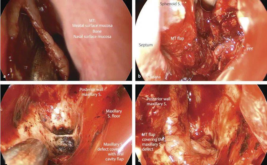 flap (mtf) for reconstruction of the maxillary sinus surface of