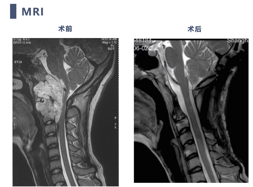 宣武有術|後路聯合極外側入路顱頸交界脊索瘤切除