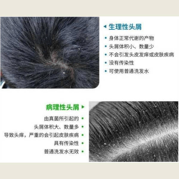 去屑去屑止痒洗发水推荐_头皮屑_头发_问题