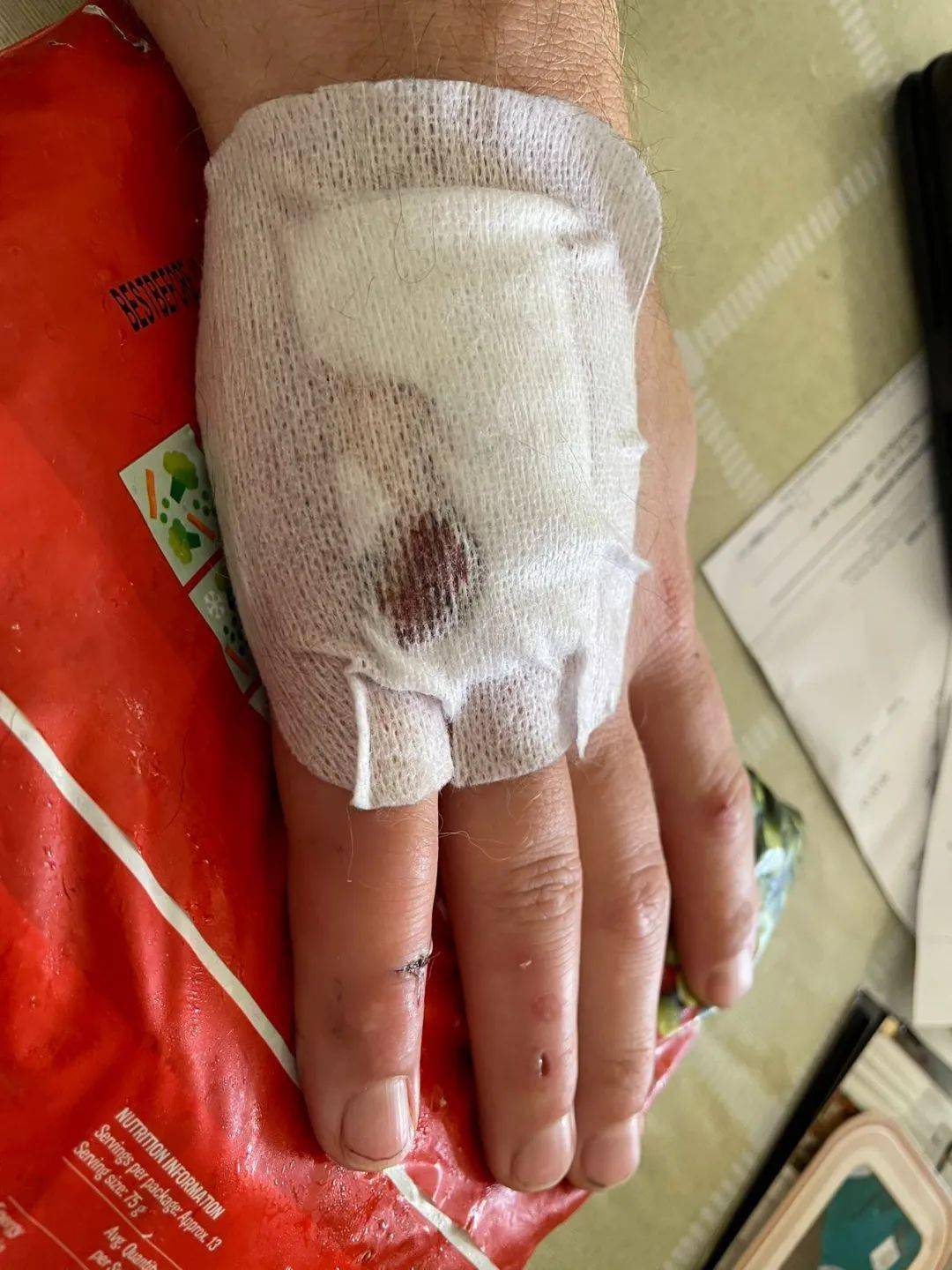 新西兰华人爆料：老公出门遭恶犬无故撕咬，鲜血淋漓！至今找不到狗和主人......