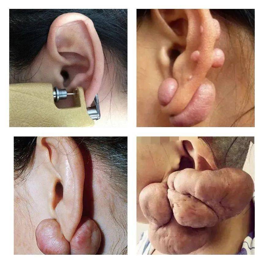 怎么判断耳洞疤痕疙瘩图片