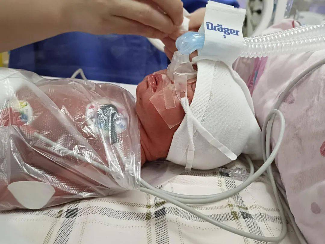 棉湖华侨医院与汕大附二专家并肩作战,28周 双胞胎早产儿顺利闯过