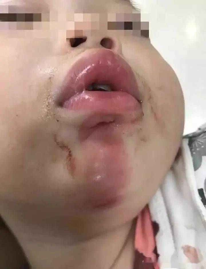 2022年,广东中山一名一岁多女孩从"遛娃神器"上摔下,导致唇部受贯通伤