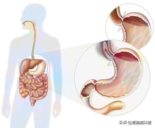 巴雷特食管饮食图片