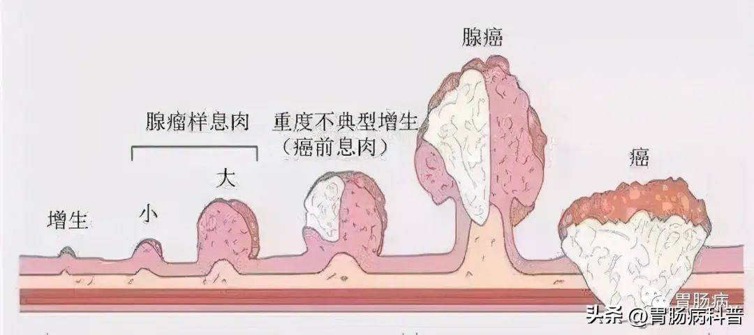 肠癌早期症状 前兆图片