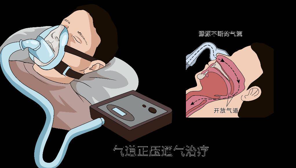 睡眠监测助你找原因_患者_进行_暂停