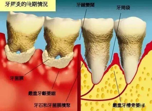 包括食物嵌塞,不良修復體,口呼吸等因素也促使牙周組織的炎症發生.