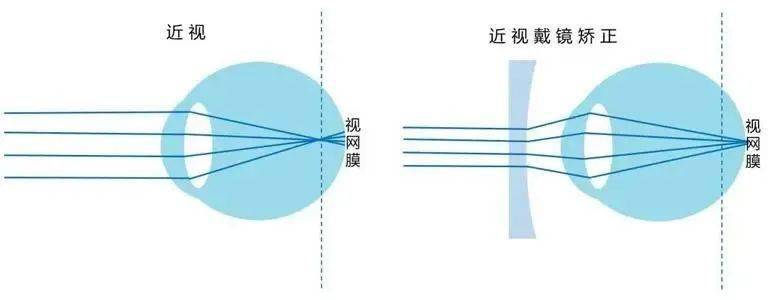 低度近视到底要不要配眼镜?专家这样分析!_度数_防控_医生