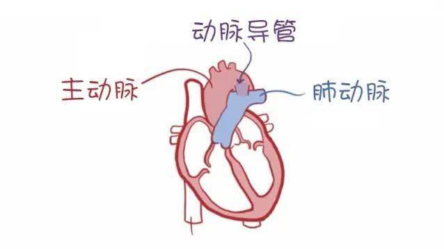 是先天性心脏病中最常见的类型之一,动脉导管连接主动脉和肺动脉的