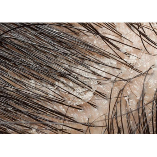 头皮痒油腻头屑多用什么洗发水?