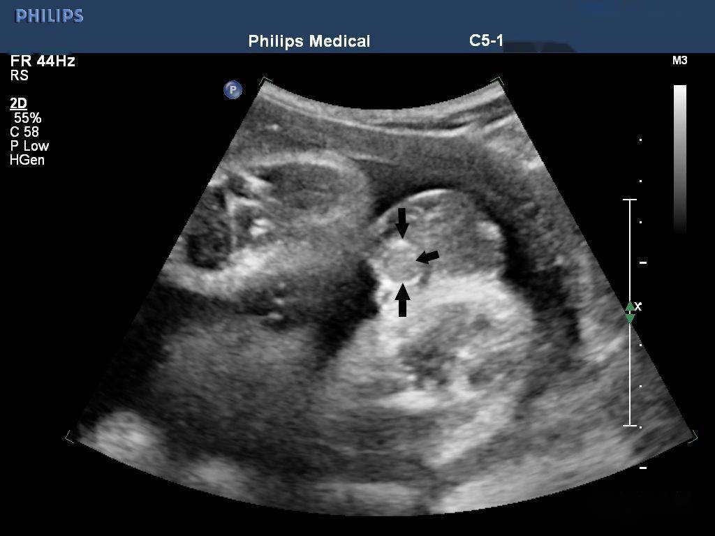 图 1 双侧阴囊内可见睾丸回声(箭头所示)随后孕妇于外院引产,经随访