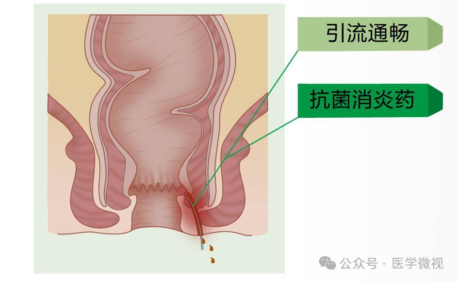 对于一些合并其他疾病的,包括肛门周围有多个瘘管的患者,炎症发作的