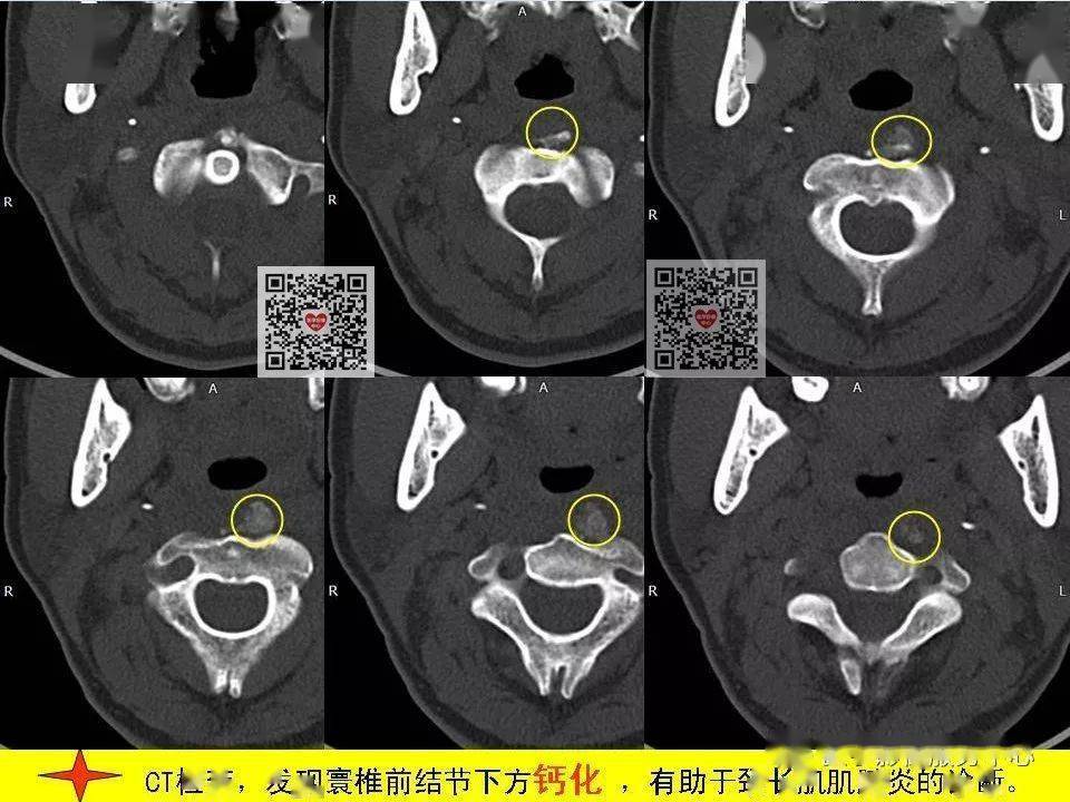 總結頸長肌肌腱炎,是以頸項疼痛為主要臨床表現的一種疾病,因頸長肌