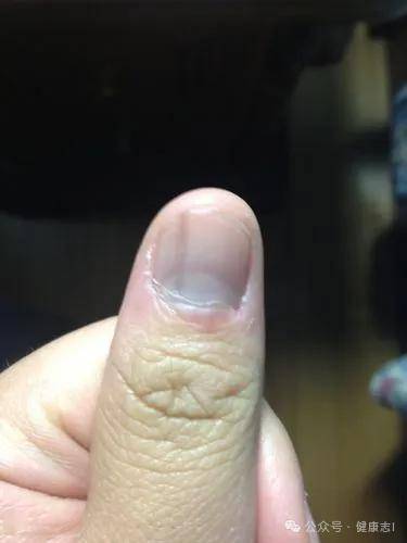 指甲呈现黑色癌症图片