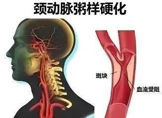 一是心臟動脈硬化,二是腦組織的動脈硬化,三是頸動脈硬化.心臟動脈