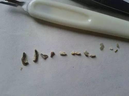 用手抠牙结石?请勿模仿._口腔_牙齿_钙化