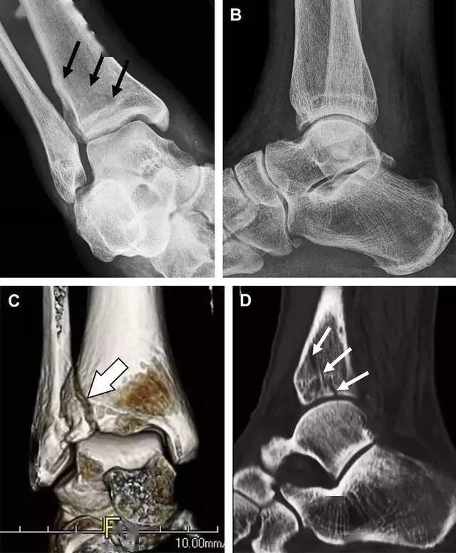 a 側位片示來源於脛骨後踝的一個小骨折碎片(箭頭),因