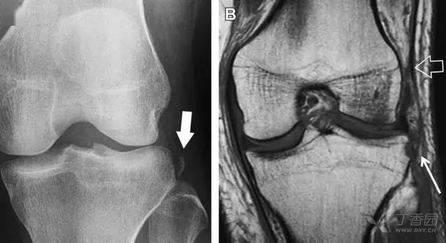 屈曲位時膝關節受到內旋暴力作用,導致皮質骨撕脫性骨折,這種骨折常