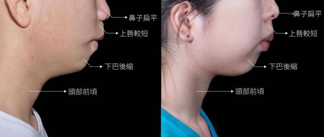 【护理园地】腺样体手术,"做"还是"不做"_阻塞_孩子_治疗